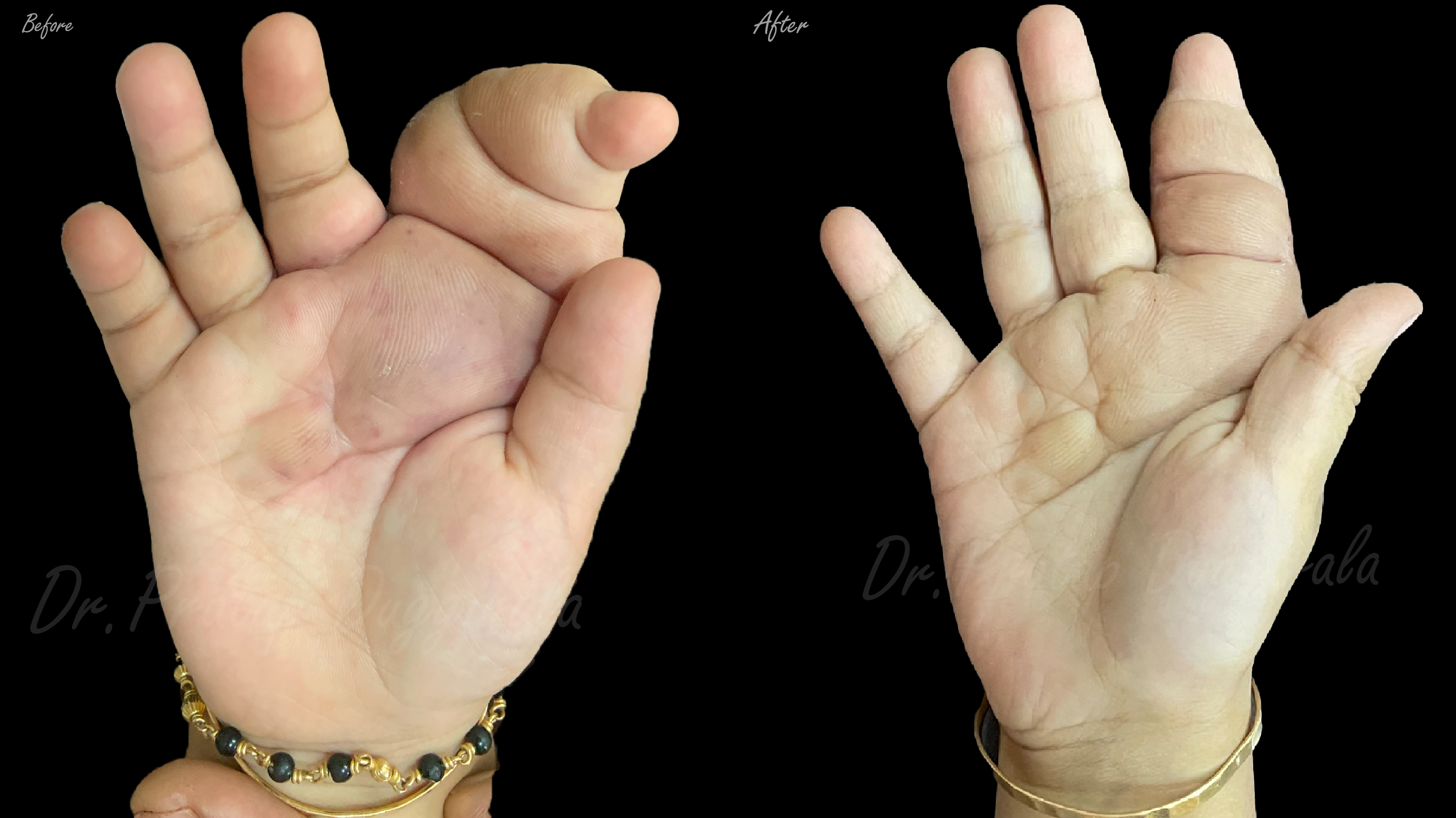 Hand Surgery