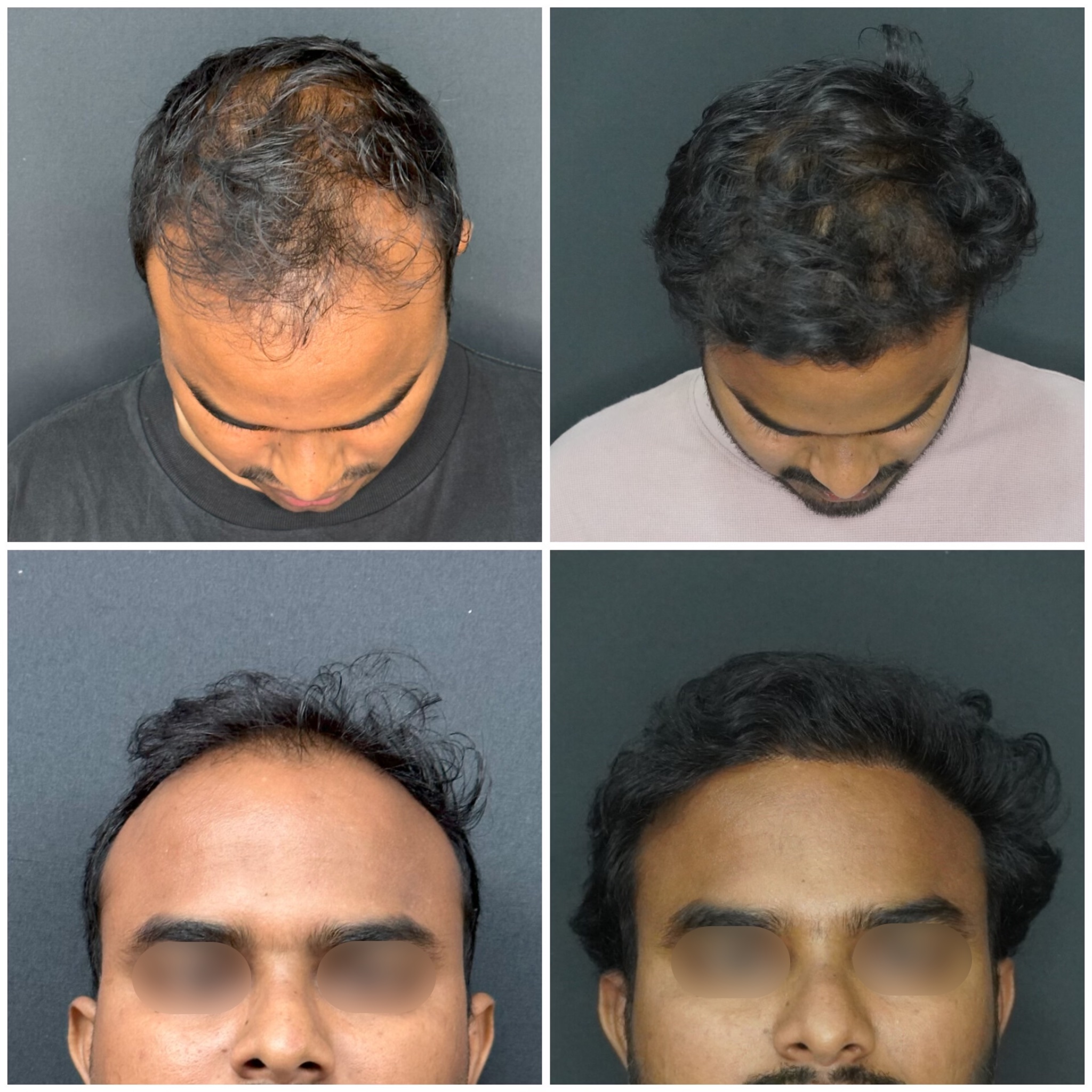 Hair Restoration (FUE / FUT)